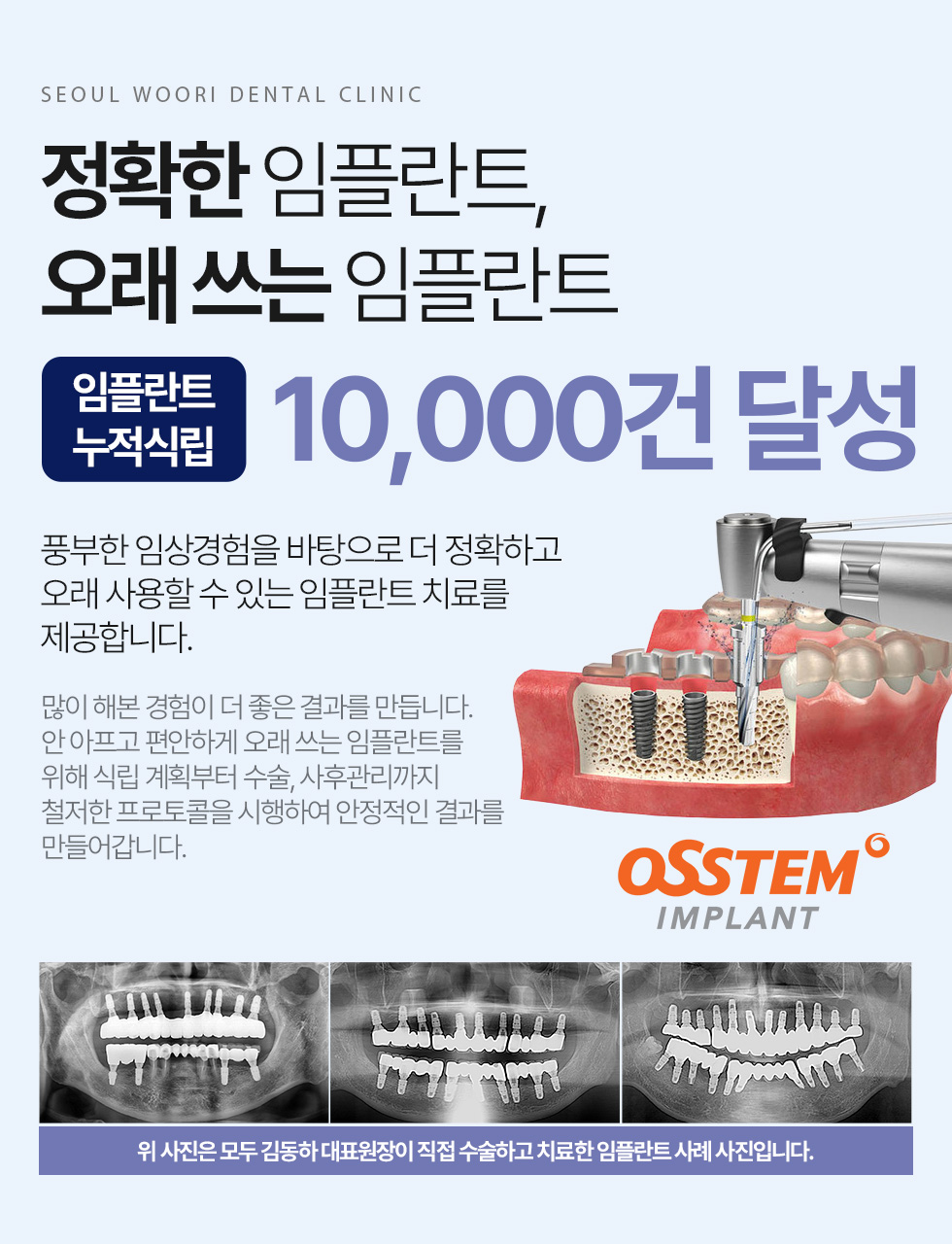 임플란트 누적식립 10,000건 달성, 정확하고 오래 쓰는 임플란트 치료